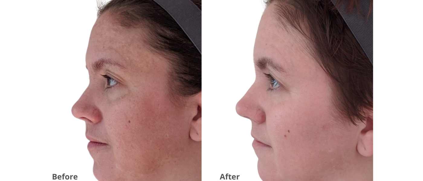 美容皮膚医学BEAUTY #13(Vol.2 No.12 medicated-acne-wash-with-bpo-