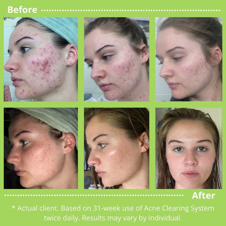 Amazing Before and After Acne Clearing