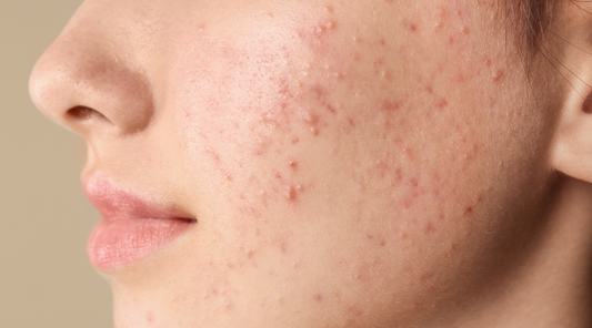 Your Top Acne Questions Answered