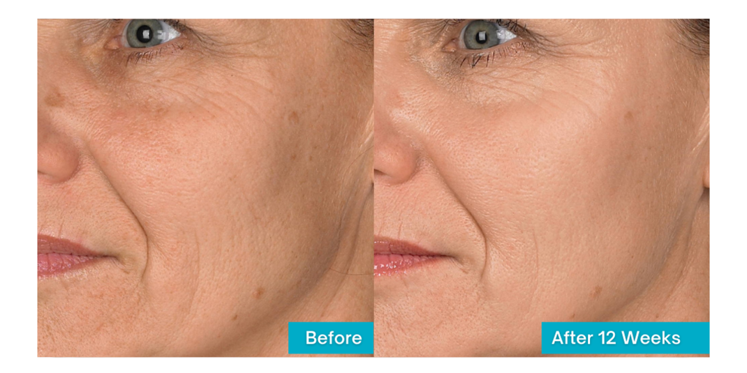 Before and After with Wrinkle Radiance Trio