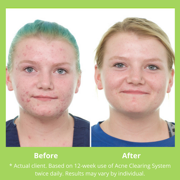 Clear Skin Results - Before and After