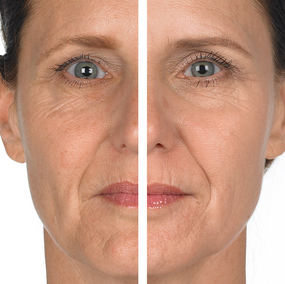 Wrinkle & Radiance Remedy Before & After MD Complete