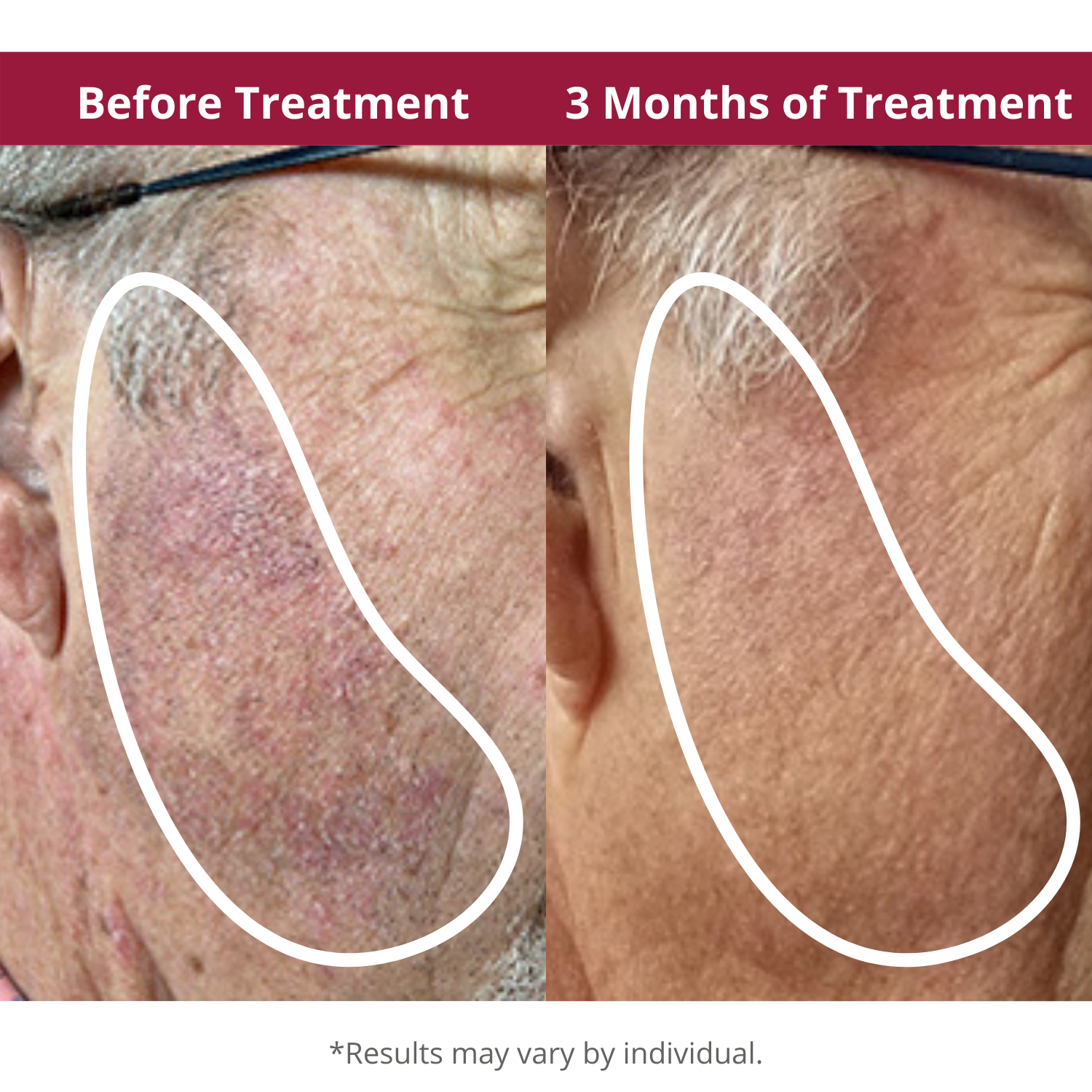 Redness Relief Before and After